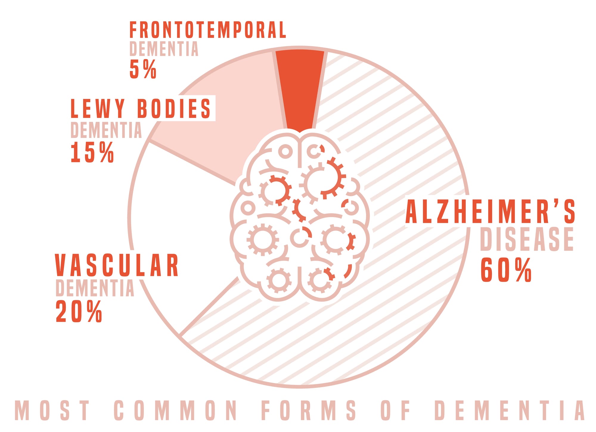 Lewy Bodies, Alzheimer's Disease Comparison